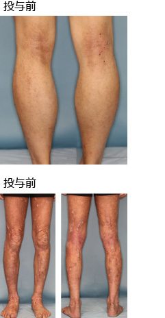 腹部に乾癬による大型の紅斑/関節に血流増加と炎症増強