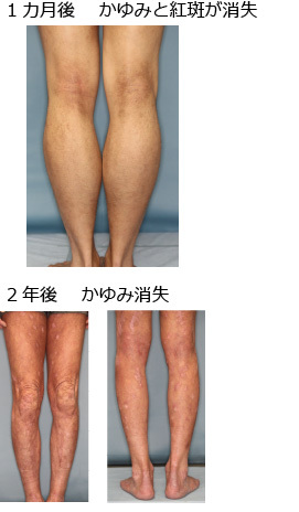 紅斑が薄くなる/関節の炎症改善